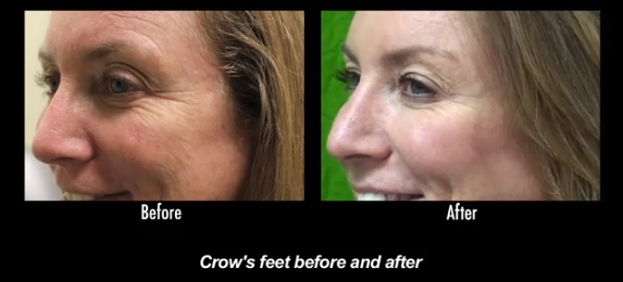 Botox rejuvenecimiento facial