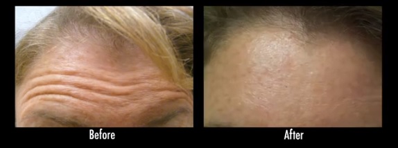 botox rejuvenecimiento