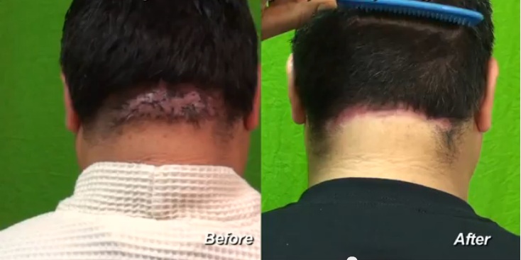 cicatrizacion queloide
