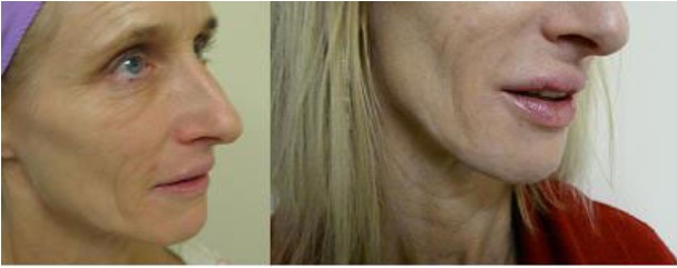juvederm para labios