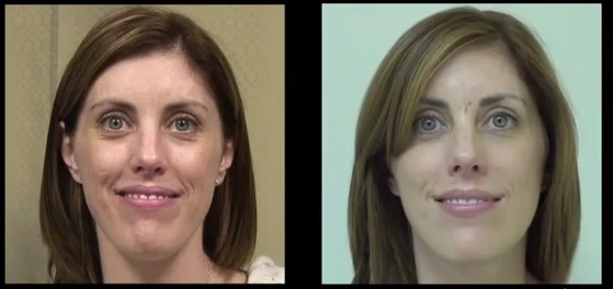 juvederm para lineas de expresion