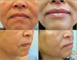 juvederm para los labios