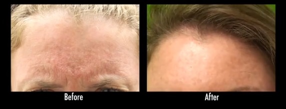 rejuvenecimiento facial