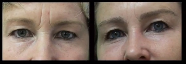 Trasplante de cejas