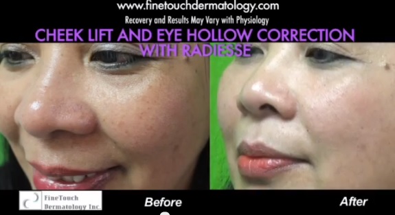 tratamiento para las ojeras