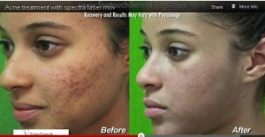 Tratamiento de acne con laser