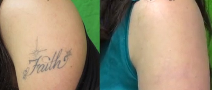 eliminacion de tatuaje con laser