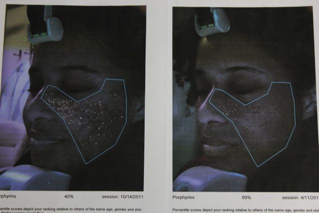 tratamiento de acne resultados
