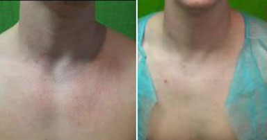 vbeam rosacea laser