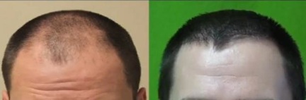 Dr U Hair Clinica