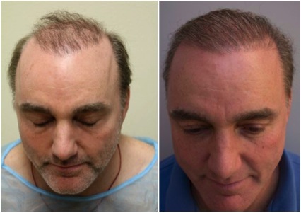 trasplante de pelo los angeles