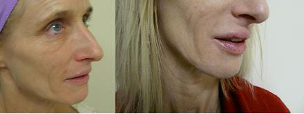juvederm_lips1