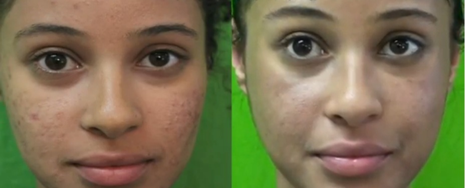cicatrices de acne