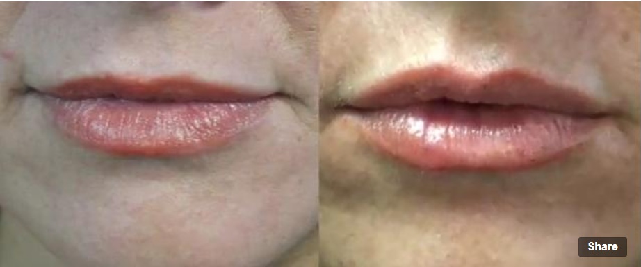 juvederm labios