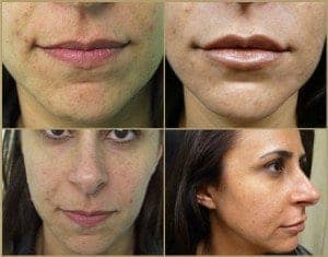 Before and after lip augmentation using hyaluronic acid dermal filler called Hydrelle by Dr U in a Hermosa Beach Patient* Before and after lip augmentation using hyaluronic acid dermal filler called Hydrelle by Dr U in a Hermosa Beach Patient*