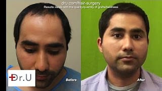 Dr. Umar Patient Sees Norwood 1 Full Hair Restoration Using Body hair grafts - Before and After Photos