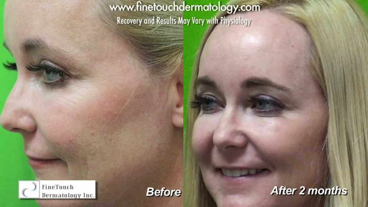 Crows feet removal before and after.