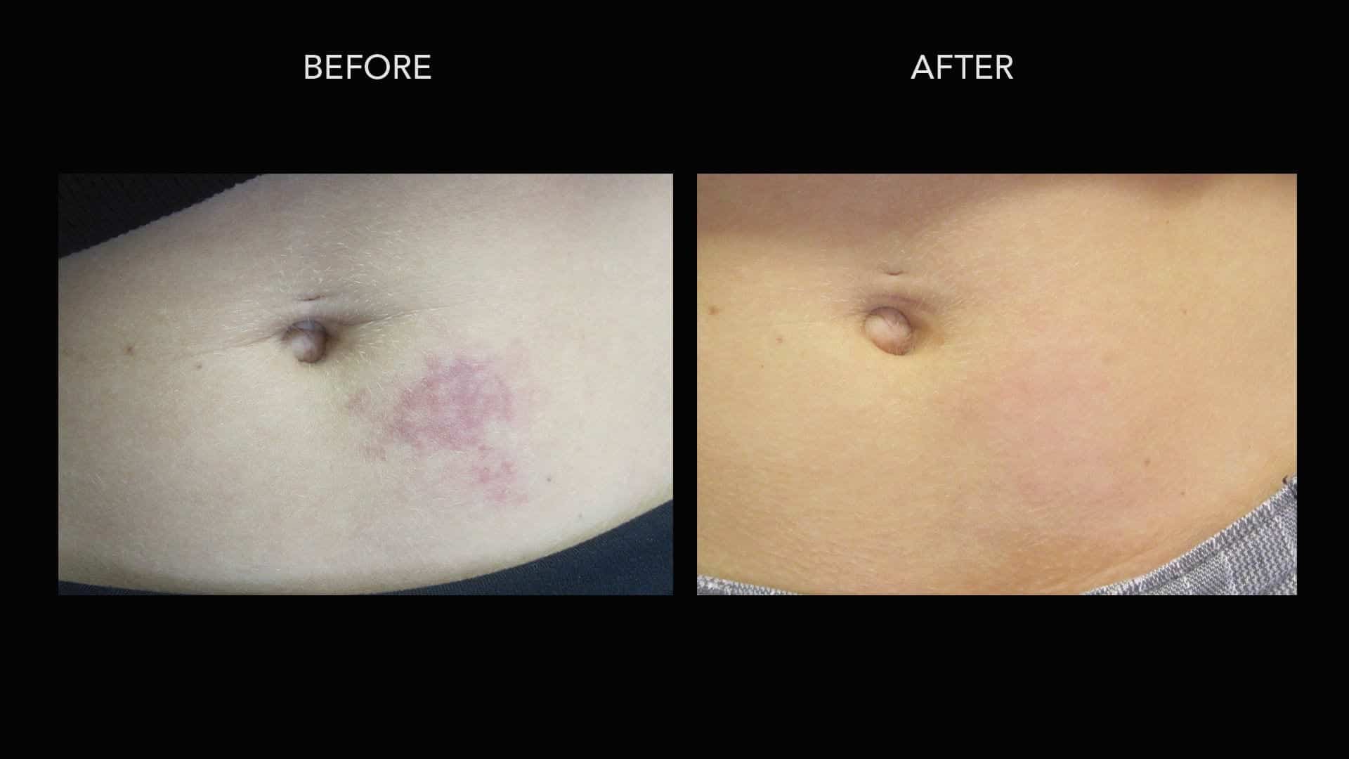 Stomach Birthmark Treatment Turning to birthmark treatment, this patient was able to greatly reduce the appearance of her stomach birthmark.