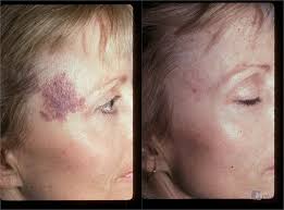 Facial Birthmark Removal Turning to birthmark removal, this patient was able to greatly reduce the appearance of her facial birthmark.