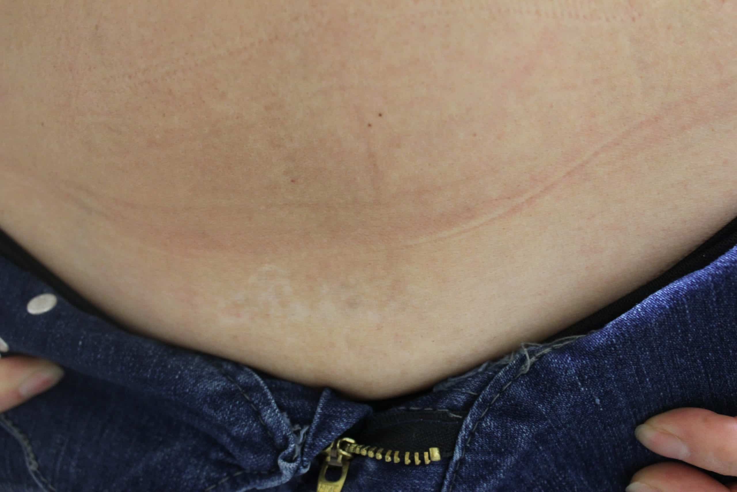 This patient is thrilled with the results, her regretful tattoo is no longer an eye sore.* This patient is thrilled with the results, her regretful tattoo is no longer an eye sore.*