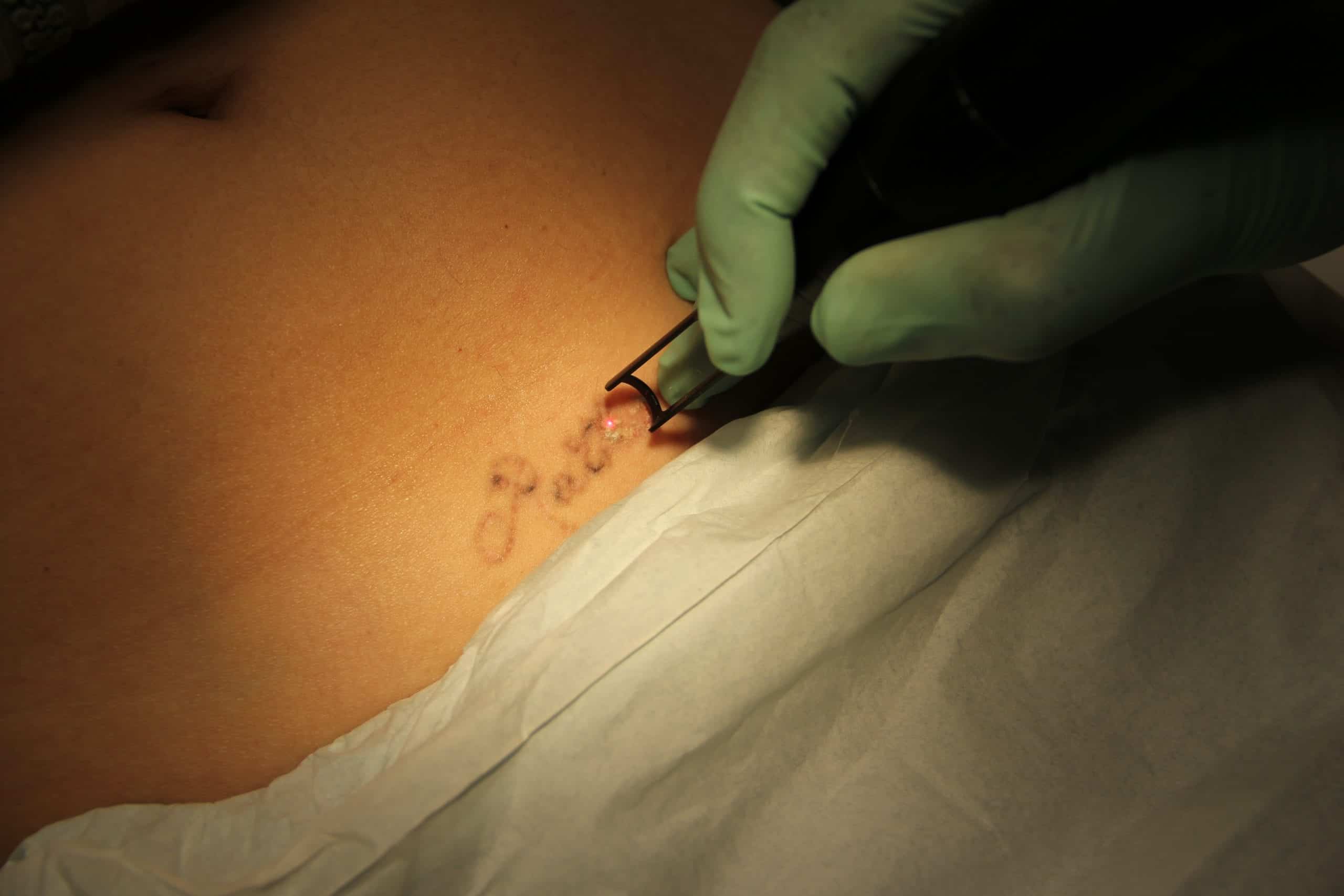 Dr. Umar uses a YAG laser over the course of several sessions to remove the tattoo. Dr. Umar uses a YAG laser over the course of several sessions to remove the tattoo.