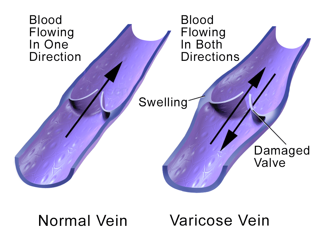Due to the damaged valve in a varicose vein, the blood can flow either way.