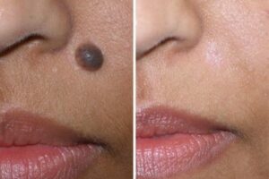 Thanks to facial mole removal treatment, this patient was able to achieve the cosmetic look she was after.