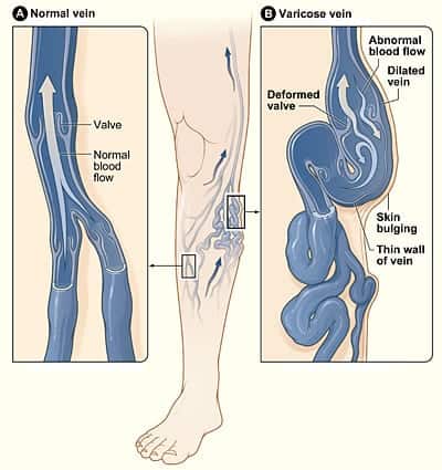 Varicose veins entail deformed valves, abnormal blood flow, and thin valve walls. 
