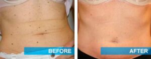 While this patient had a lot of moles covering her stomach, she was able to significantly reduce the amount thanks to skin mole treatment.
