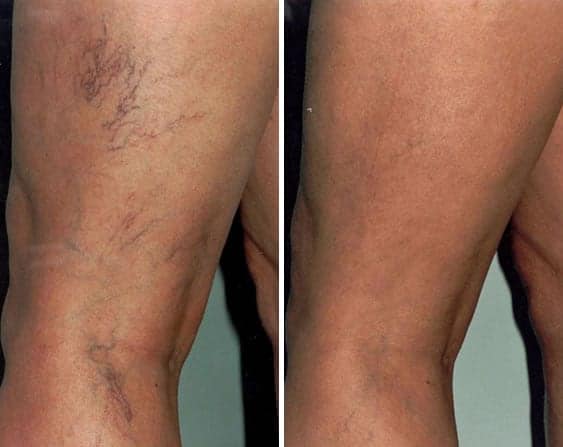 Beginning with a lot of visible veins in the thighs, this patient was able to successfully remove veins in legs. 