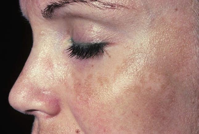 After reaching a certain point, melasma natural treatment plans are not very effective.