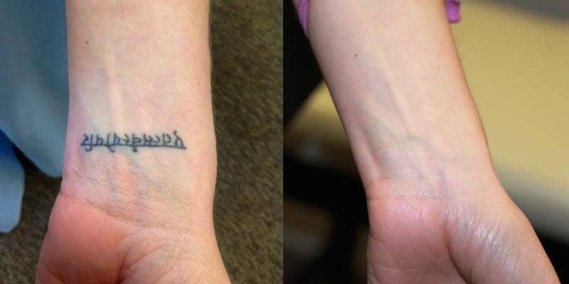 Tattoo removal by laser: laser tattoo removal before and after Tattoo removal by laser: laser tattoo removal before and after
