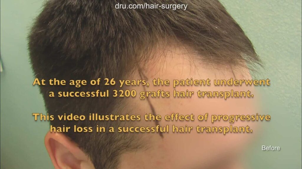 Do hair transplants last?: Patient before treatment by Dr. Umar