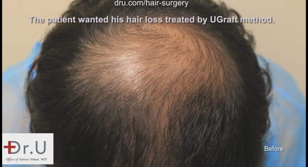 Rear view of the patient's hair loss before treatment by Dr. Umar