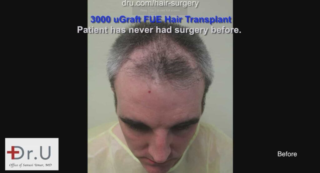 Consult with Dr. Umar on how to address thinning hair