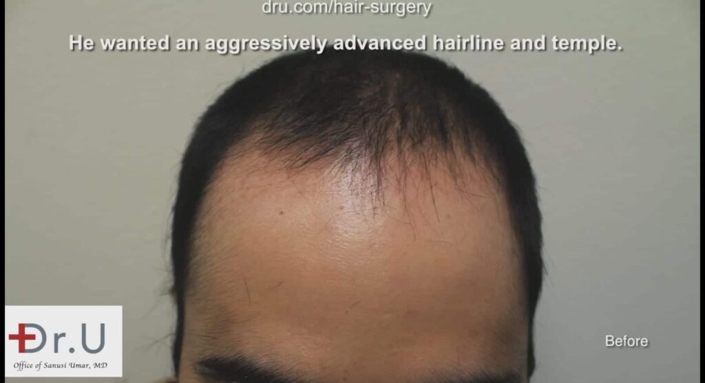 The patient experienced a receding hairline and loss of temple coverage before seeing Dr. Umar