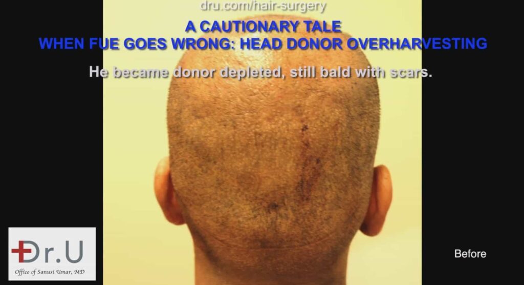 The patient experienced hair loss and scarring from a botched previous procedure