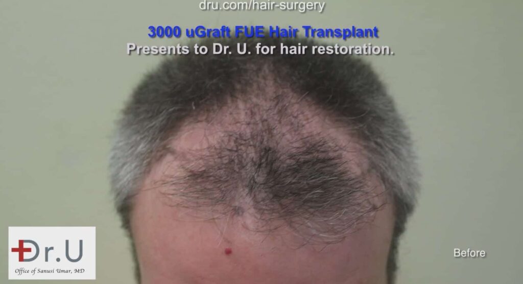 Thinning hair men: Erosion of the temple points and hairline before treatment