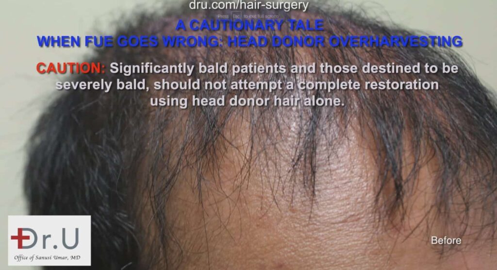 Hair loss at hairline before treatment