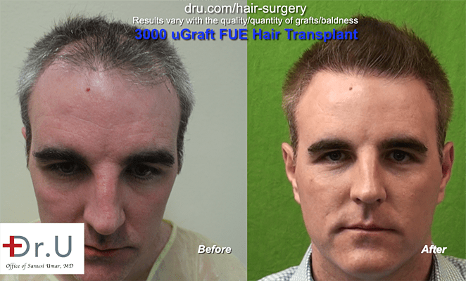 Before and After Dr.UGraft to address thinning hair men