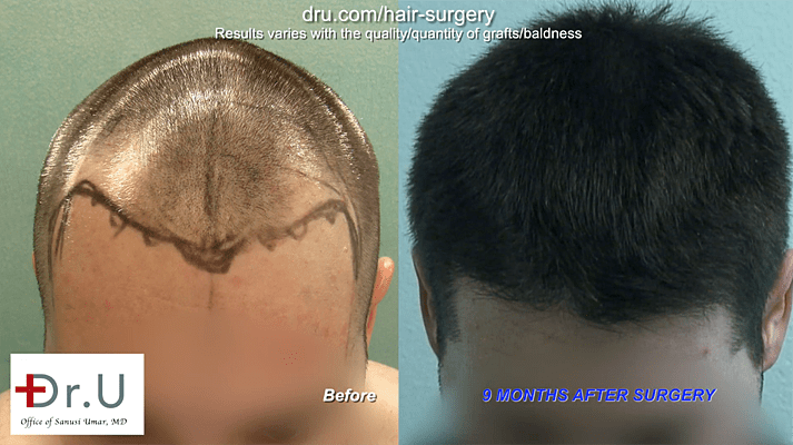 FUE hair transplant at 26: Before and After Progressive hair loss solution