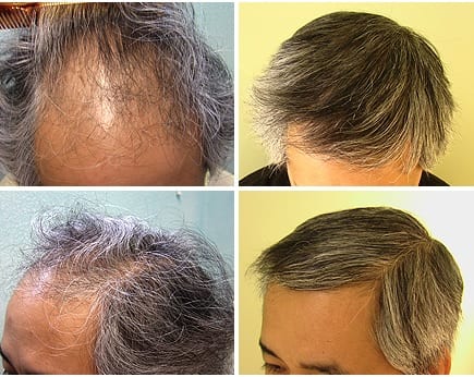 Before and after: Asian hair loss transplant with the DrUGraft procedure
