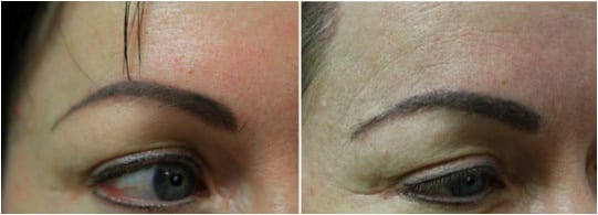 Eyebrow graft with the DrUGraft method Eyebrow graft with the DrUGraft method