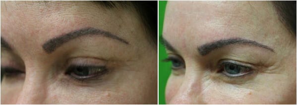 Before and after eyebrow hair transplant with Dr. Umar Before and after eyebrow hair transplant with Dr. Umar
