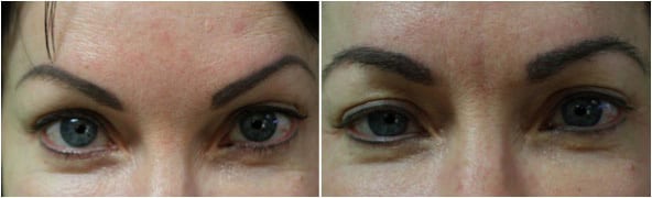 Hair transplant for eyebrows: Before and after eyebrow graft Hair transplant for eyebrows: Before and after eyebrow graft