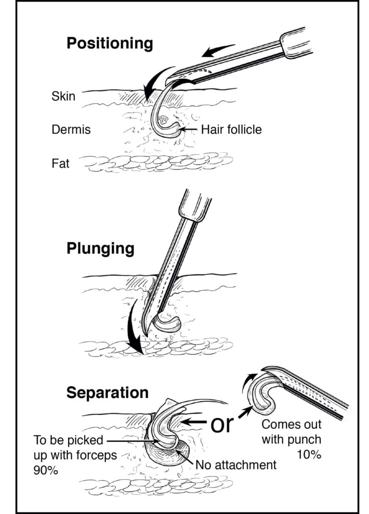 The Dr.UPunch Curl allows for African American hair restoration The Dr.UPunch Curl allows for African American hair restoration