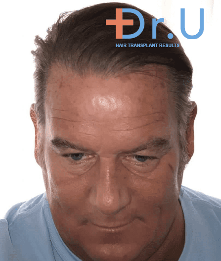 After treatment by Dr. Umar, this patient showed no signs of hair loss After treatment by Dr. Umar, this patient showed no signs of hair loss