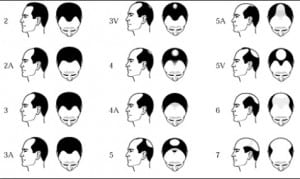 Hair loss causes: The Norwood-Hamilton Scale Hair loss causes: The Norwood-Hamilton Scale