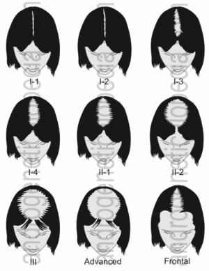 Hair loss in women: the Savin Scale Hair loss in women: the Savin Scale