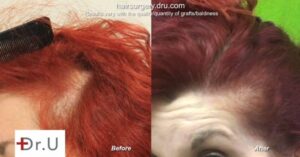 Female hair restoration before and after: Traction alopecia can be treated with hair transplant for women. Female hair restoration before and after: Traction alopecia can be treated with hair transplant for women.